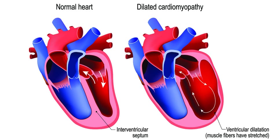 DCM-Heart-Diagram-Large.jpg